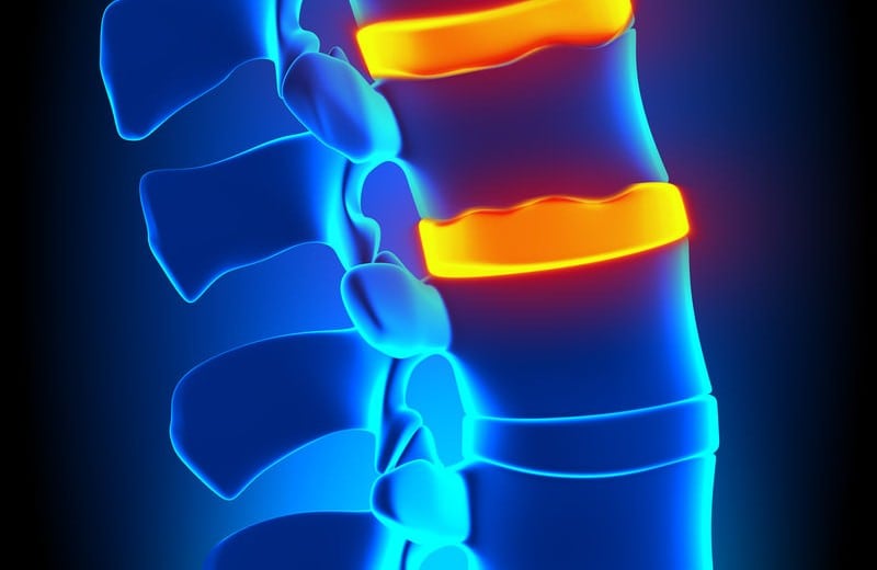 Conditions Herniated Discs by Santa Ana Pain Clinic 1 1 800x520 - Herniated Discs