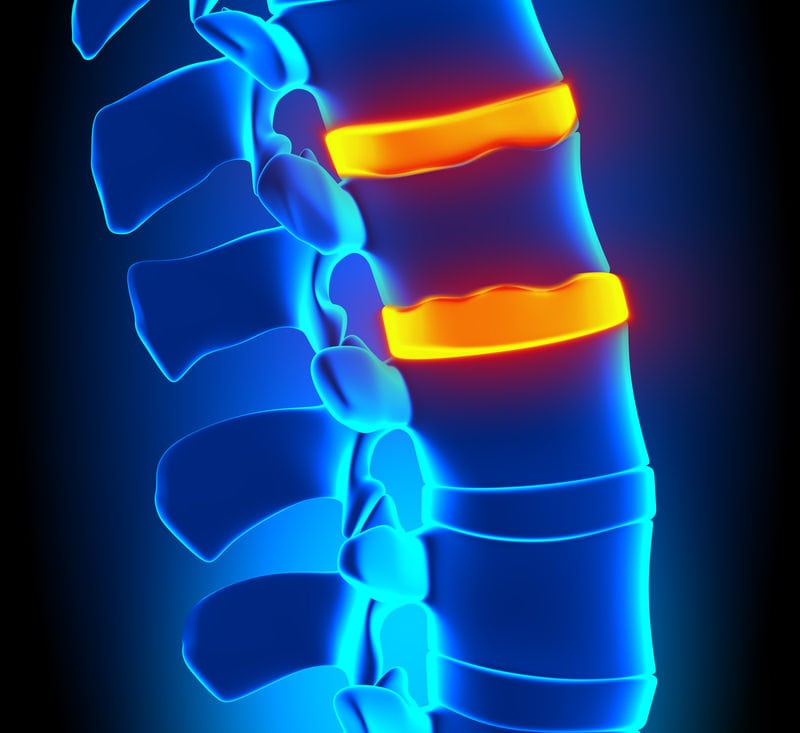 Conditions Herniated Discs by Santa Ana Pain Clinic 1 1 - Herniated Discs
