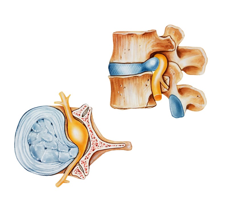 Conditions Herniated Discs by Santa Ana Pain Clinic 2 1 - Herniated Discs
