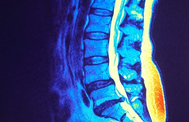 Conditions Spinal Stenosis by Santa Ana Pain Clinic 1 1 800x520 - Spinal Stenosis