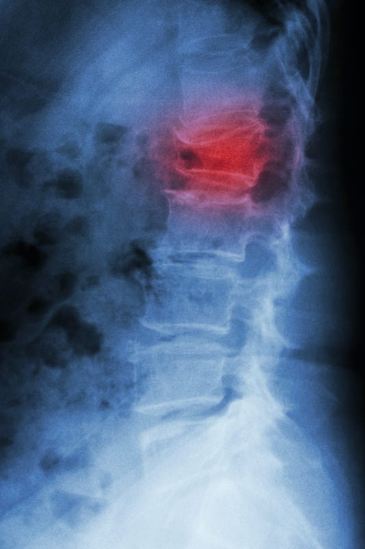 Conditions Vertebral Compression Fracture by Santa Ana Pain Clinic 2 1 - Vertebral Compression Fracture