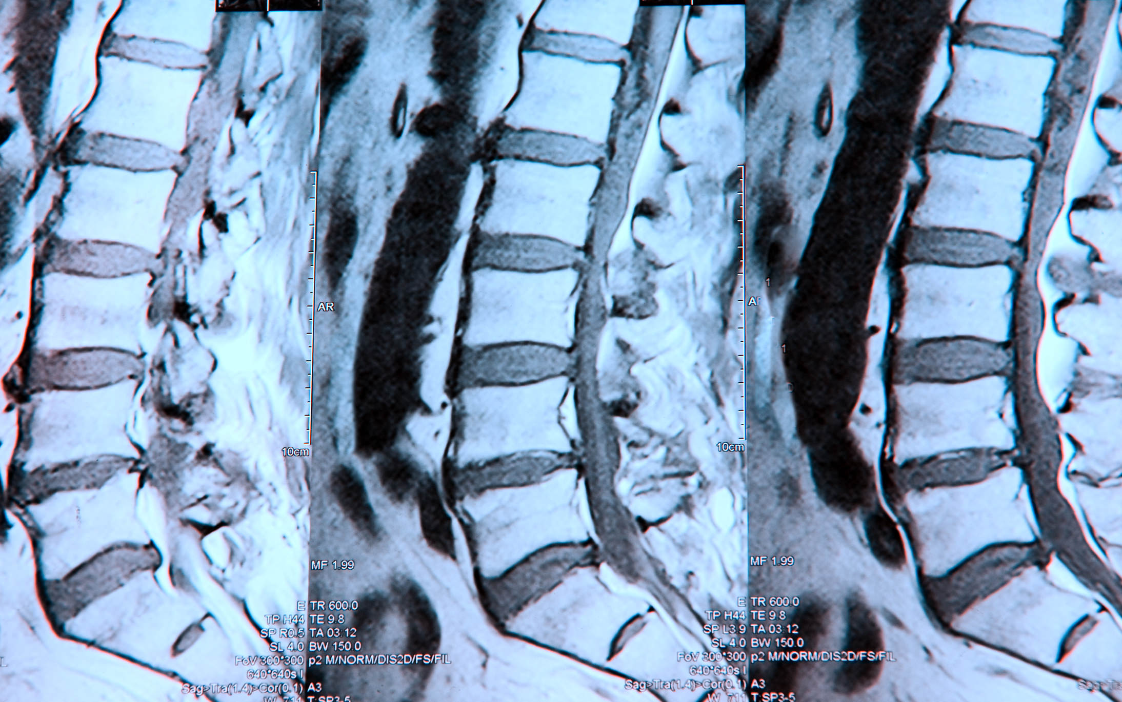 Treatments Spinal Cord Stimulation by Santa Ana Pain Clinic 2 1 - Spinal Cord Stimulation