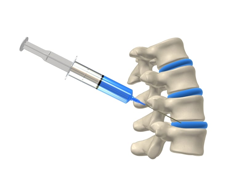 Injections for Back Pain Santa Ana Pain Clinic 3 - Injections for Back Pain